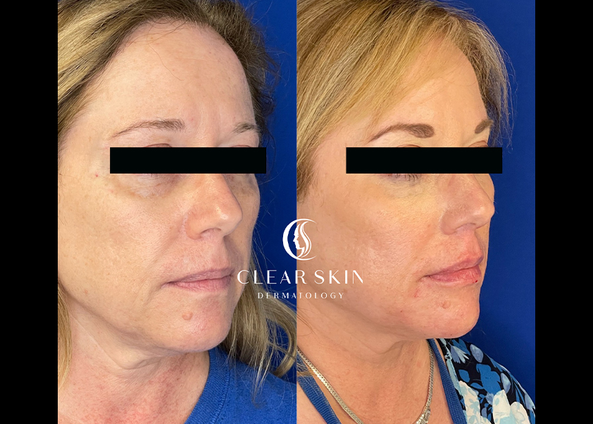 woman before and after getting dermal fillers in Clearwater, FL