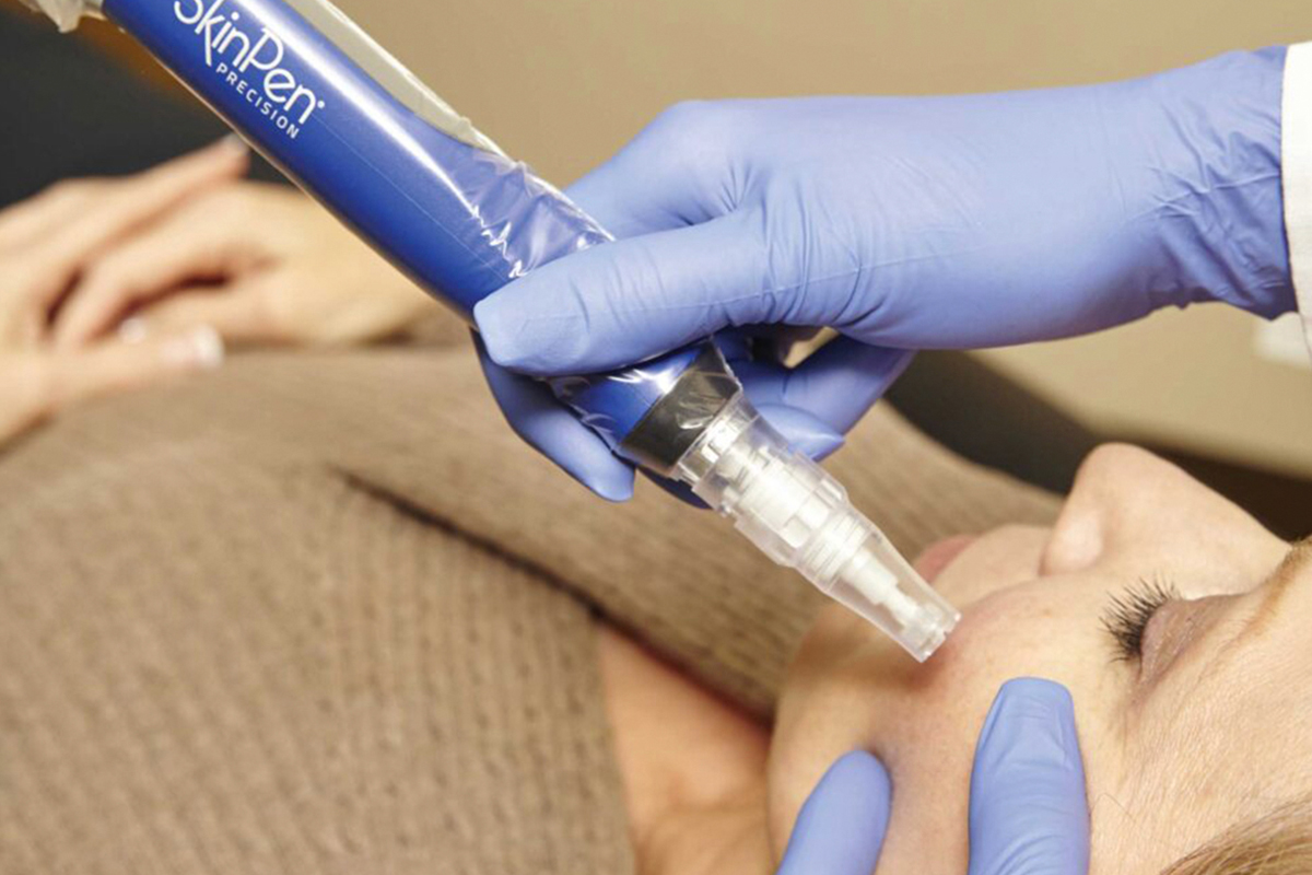 patient getting microneedling treatment in Clearwater, FL